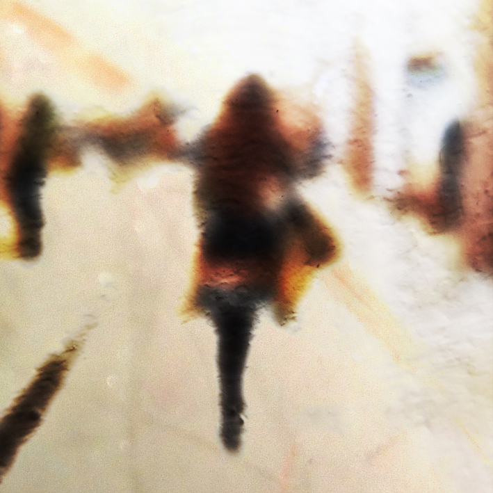 Żylaki – powikłania